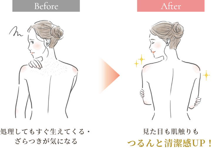 Before 処理してもすぐ生えてくる・ざらつきが気になる After 見た目も肌触りもつるんと清潔感UP!